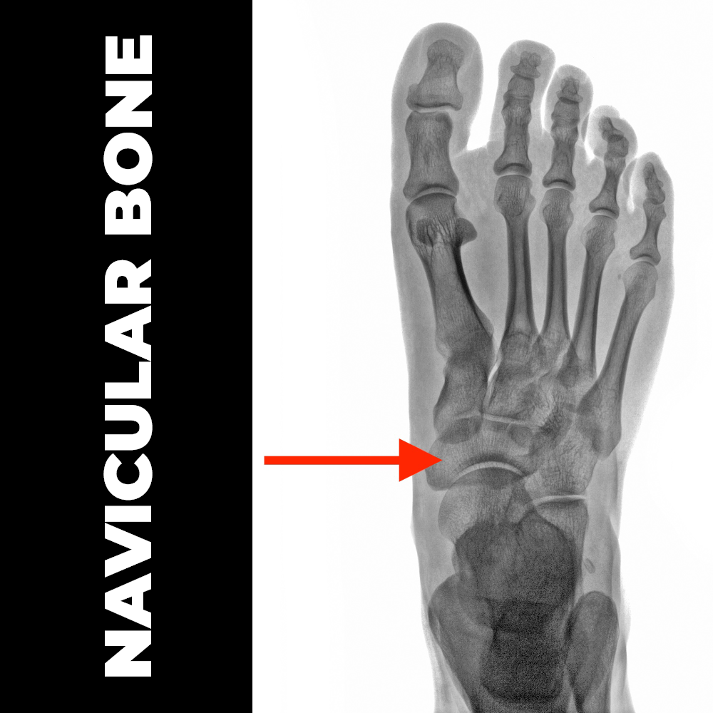 Navicular Bone Used to Kick Footballs